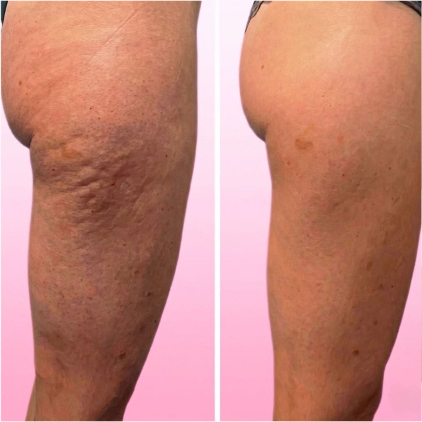 Masajeador Anticelulitis